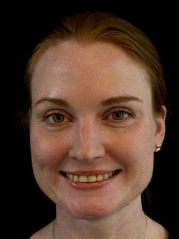 Before cosmetic dentistry, front view