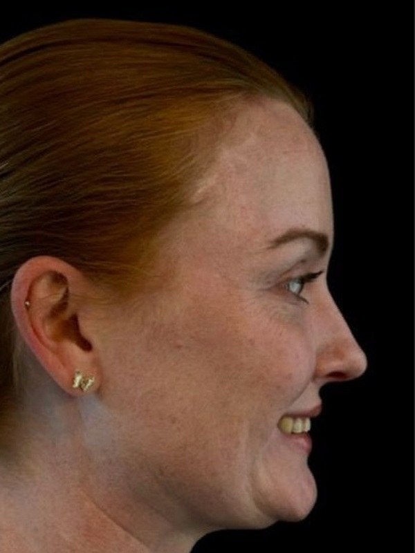 Before cosmetic dentistry, profile view