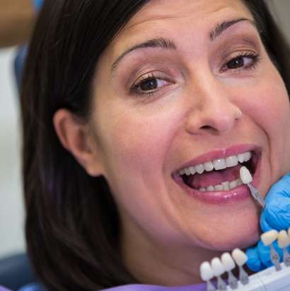 Veneers
