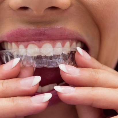 Invisalign
